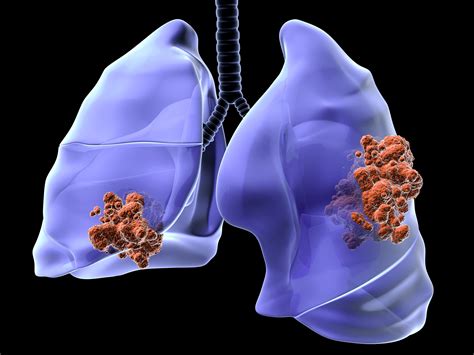 patologie cistiche del polmone